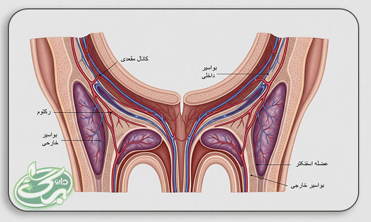 هموروئید چیست؟